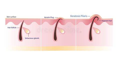 Diagram illustrating the hair follicle and how keratin buildup causes KP.