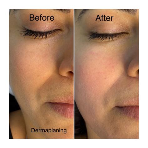 A split image showing a 'before' and 'after' of a dermaplaning treatment, highlighting the removal of peach fuzz and dead skin cells.