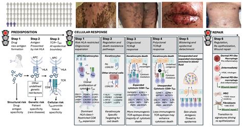Diagram illustrating the progression from Stevens-Johnson Syndrome to Toxic Epidermal Necrolysis, showing increasing percentages of skin affected.