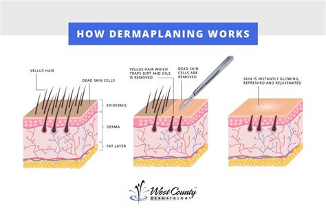 Illustration showing the layers of skin and how dermaplaning removes dead skin cells and peach fuzz.