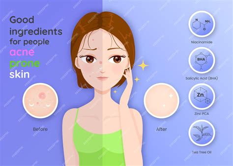 Infographic detailing key ingredients for acne-prone skin and their benefits