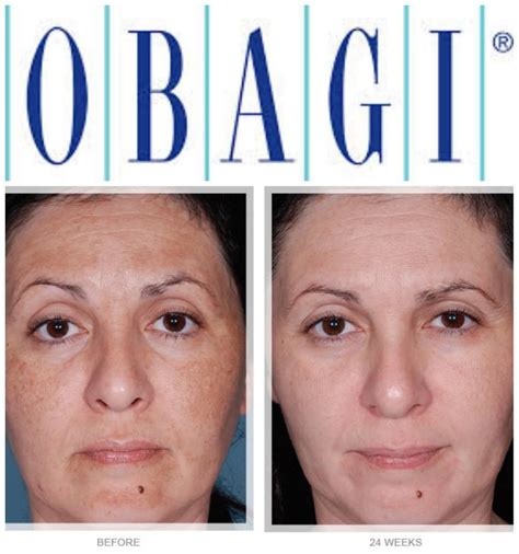 Split image showing before and after application of Obagi Hydrate, highlighting reduced fine lines and increased radiance