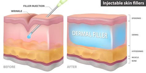 An illustration showing the layers of the skin and where dermal fillers are injected.
