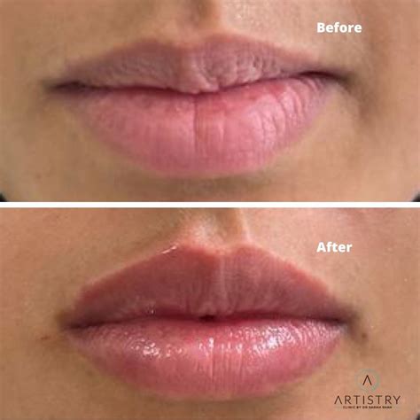 A split image showing before and after photos of lip filler treatments.