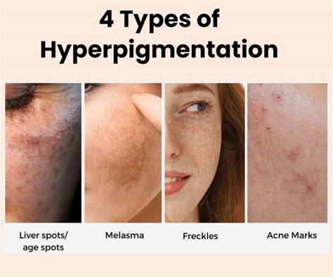 Illustration showing common areas of skin hyperpigmentation such as knees, neck, underarms, thighs, and groin.