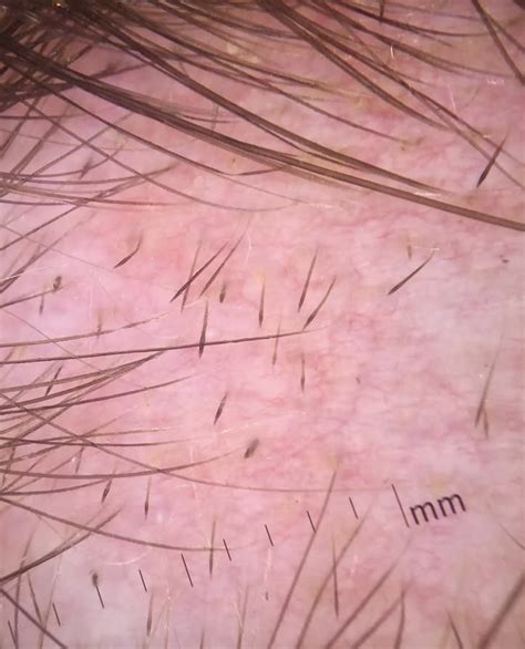 Close-up image of exclamation mark hairs, a diagnostic sign of alopecia areata.