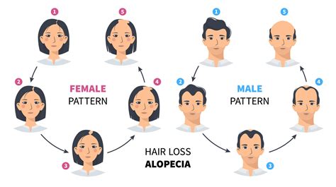 Diagram showing the typical patterns of androgenetic alopecia in men and women.