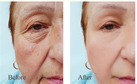Before and after images showcasing the reduction in wrinkles after using a retinol product.