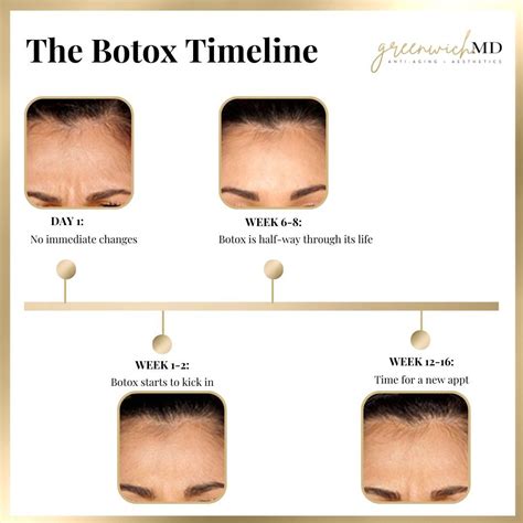 Timeline illustrating the typical duration of Botox effects and side effects, emphasizing that most are temporary.