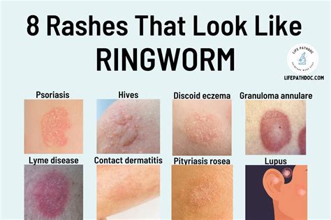 Infographic illustrating the different types of ringworm infections on the human body and their characteristic appearances.
