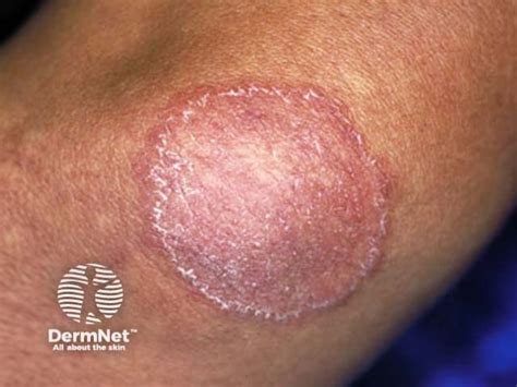 Close-up photograph of a typical ring-shaped rash characteristic of Tinea Corporis.
