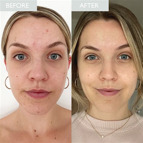 before and after photos of skin treated with Simply Clean, showing reduced breakouts and improved clarity