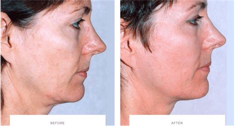 A split image showing before and after results of a skin tightening treatment, highlighting reduced wrinkles and lifted skin.