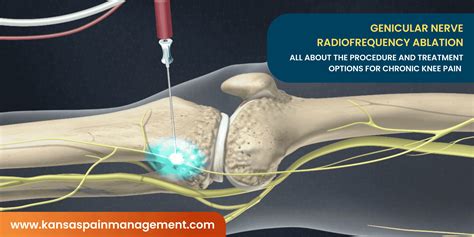 A diagram illustrating how radiofrequency energy penetrates the epidermis to stimulate collagen production.