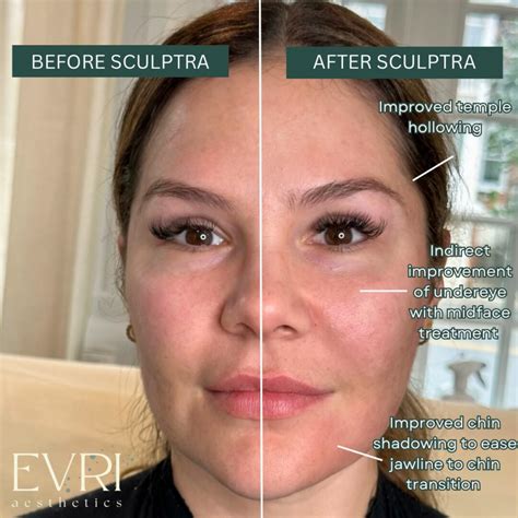 Infographic comparing immediate results of hyaluronic acid fillers versus gradual collagen stimulation of Sculptra